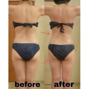 年内にスッキリボディーを叶えたい方へ