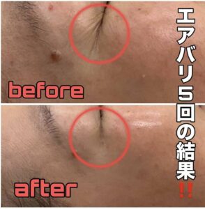 空気圧(エアバリ）でくすみ、しわ撃退！！